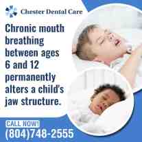 Child sleeping with mouth open, illustrating chronic mouth breathing and its potential impact on jaw development and oral health.