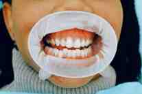 Gum treatment at Chester Dental Care in Richmond, VA